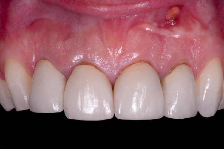 Ryc. 2. Przekroje w pozycjach zębów 21 i 22 ukazują olbrzymi defekt okołowierzchołkowy, poszarpane wierzchołki zębów oraz pozostałości biomateriału przerośniętego ziarniną.