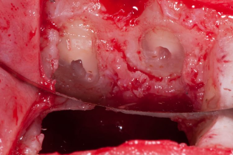 Ryc. 12. Widok korzeni zębów z gutaperką w świetle kanałów i wolna przestrzeń wokół gutaperki. Niskiej jakości leczenie endodontyczne oraz brak szczelności mogą być przyczyną procesu zapalnego.