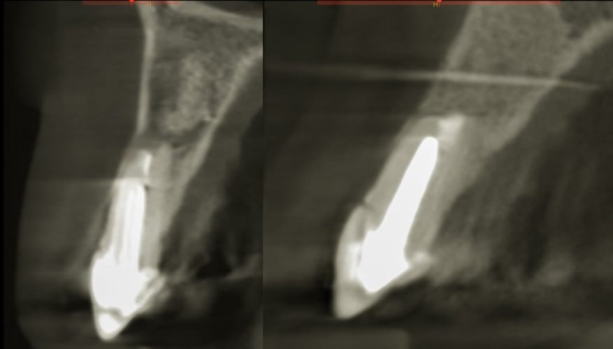 Ryc. 30. Zregenerowana kość wokół wierzchołka korzenia pozwala na planowanie implantacji natychmiastowej jako techniki umożliwiającej także podtrzymanie pozycji tkanek miękkich.