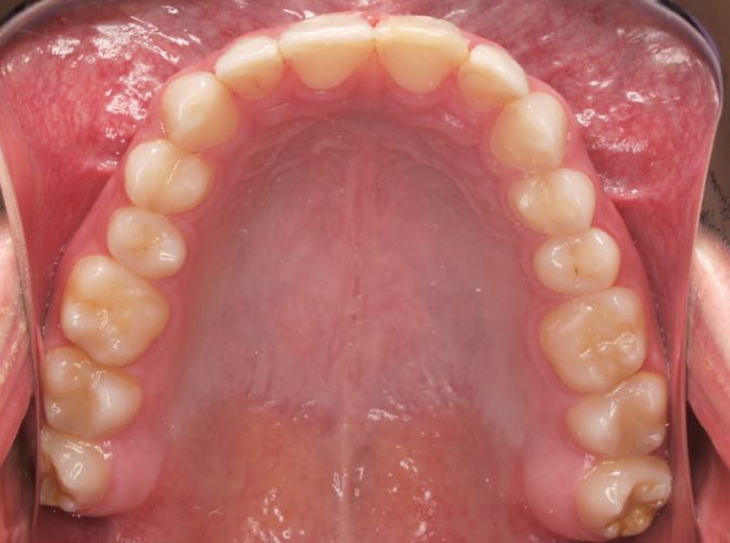 Ryc. 1. Uzębienie 20-letniego pacjenta z objawami erozji większości zębów. Pacjent zgłosił się z powodu nadwrażliwości i zmniejszającej się wysokości koron klinicznych. Od około 7 lat pacjent wypija do 2 litrów napojów energetyzujących dziennie.