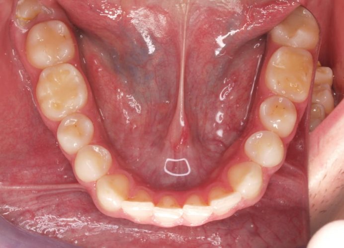 Ryc. 2. Uzębienie 20-letniego pacjenta z objawami erozji większości zębów. Pacjent zgłosił się z powodu nadwrażliwości i zmniejszającej się wysokości koron klinicznych. Od około 7 lat pacjent wypija do 2 litrów napojów energetyzujących dziennie.