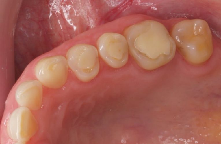 Ryc. 3. Uzębienie pacjentki, lat 26, z bulimią. Erozja wszystkich zębów szczęki.