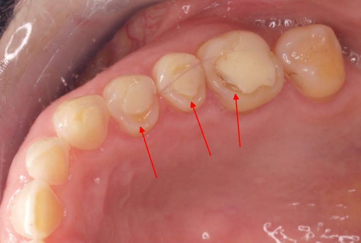 Ryc. 4. Uzębienie tej samej pacjentki po 3 latach. Widoczna postępująca utrata tkanek zębów na granicy wypełnień.