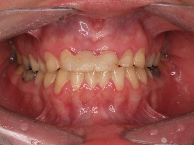 Ryc. 5. Stan uzębienia pacjentki z bulimią przed leczeniem. Uogólniona destrukcja zębów na skutek erozji. Zaburzenia poziomu zenitów dziąsłowych zębów górnych.