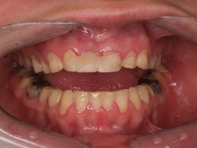 Ryc. 6. Stan uzębienia pacjentki z bulimią przed leczeniem. Uogólniona destrukcja zębów na skutek erozji. Zaburzenia poziomu zenitów dziąsłowych zębów górnych.
