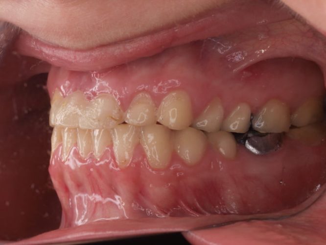 Ryc. 7. Stan uzębienia pacjentki z bulimią przed leczeniem. Uogólniona destrukcja zębów na skutek erozji. Zaburzenia poziomu zenitów dziąsłowych zębów górnych.