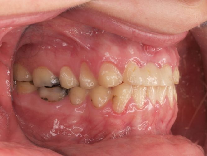 Ryc. 8. Stan uzębienia pacjentki z bulimią przed leczeniem. Uogólniona destrukcja zębów na skutek erozji. Zaburzenia poziomu zenitów dziąsłowych zębów górnych.