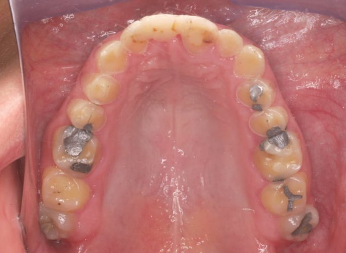 Ryc. 9. Stan uzębienia pacjentki z bulimią przed leczeniem. Uogólniona destrukcja zębów na skutek erozji. Zaburzenia poziomu zenitów dziąsłowych zębów górnych.