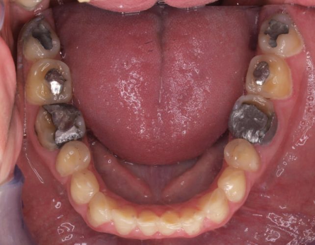 Ryc. 10. Stan uzębienia pacjentki z bulimią przed leczeniem. Uogólniona destrukcja zębów na skutek erozji. Zaburzenia poziomu zenitów dziąsłowych zębów górnych.