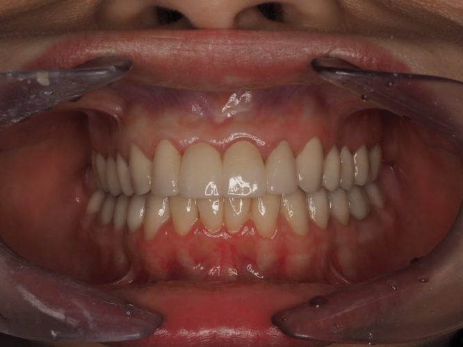 Ryc. 11. Stan po zakończeniu leczenia protetycznego poprzedzonego chirurgicznym wydłużeniem koron wszystkich górnych zębów oraz dolnych zębów trzonowych.