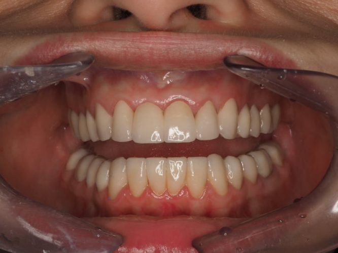 Ryc. 12. Stan po zakończeniu leczenia protetycznego poprzedzonego chirurgicznym wydłużeniem koron wszystkich górnych zębów oraz dolnych zębów trzonowych.