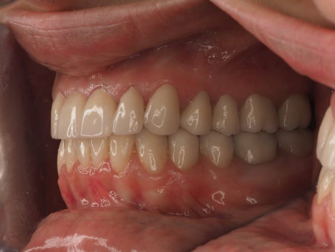 Ryc. 13. Stan po zakończeniu leczenia protetycznego poprzedzonego chirurgicznym wydłużeniem koron wszystkich górnych zębów oraz dolnych zębów trzonowych.