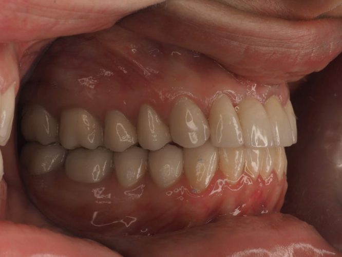Ryc. 14. Stan po zakończeniu leczenia protetycznego poprzedzonego chirurgicznym wydłużeniem koron wszystkich górnych zębów oraz dolnych zębów trzonowych.