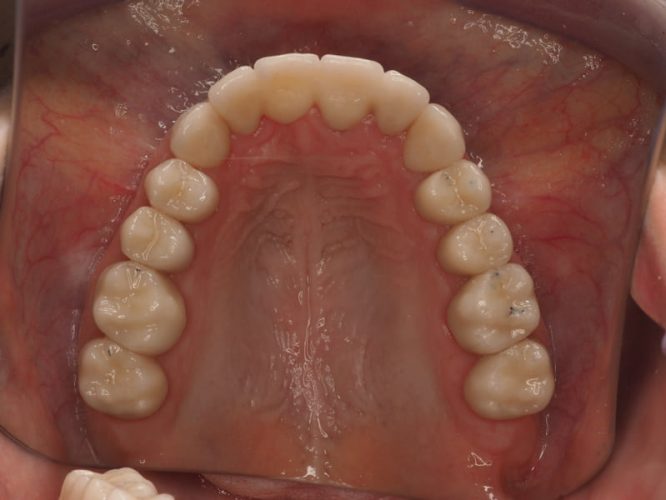 Ryc. 15. Stan po zakończeniu leczenia protetycznego poprzedzonego chirurgicznym wydłużeniem koron wszystkich górnych zębów oraz dolnych zębów trzonowych.