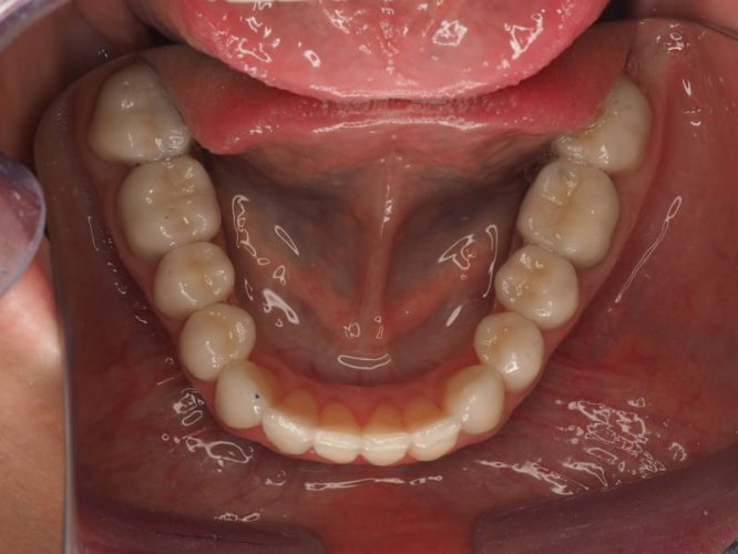 Ryc. 16. Stan po zakończeniu leczenia protetycznego poprzedzonego chirurgicznym wydłużeniem koron wszystkich górnych zębów oraz dolnych zębów trzonowych.