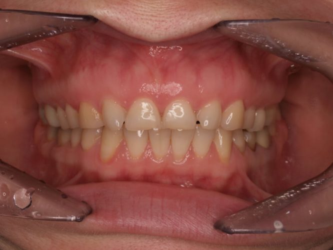 Ryc. 19 a. Pacjentka, lat 28, z erozją zębów spowodowaną przez bulimię – stan przed leczeniem.