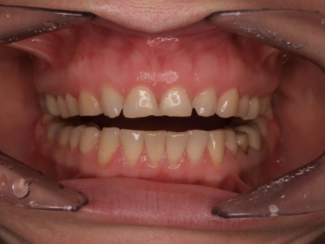 Ryc. 19 b. Pacjentka, lat 28, z erozją zębów spowodowaną przez bulimię – stan przed leczeniem.