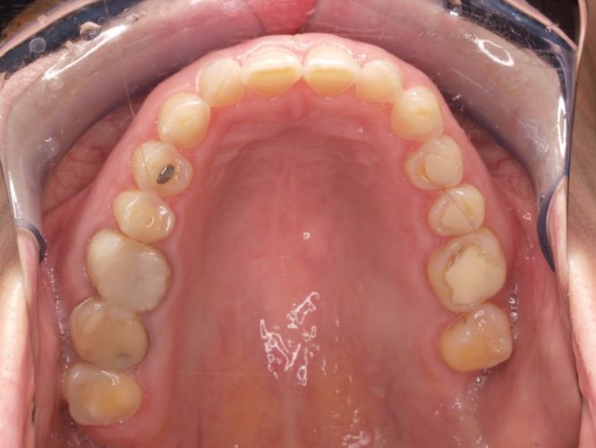 Ryc. 19 c. Pacjentka, lat 28, z erozją zębów spowodowaną przez bulimię – stan przed leczeniem.