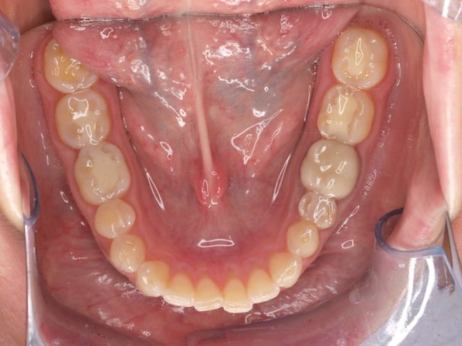 Ryc. 19 d. Pacjentka, lat 28, z erozją zębów spowodowaną przez bulimię – stan przed leczeniem.