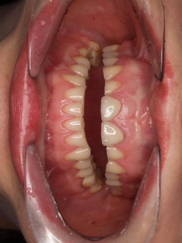 Ryc. 20 a–d. Pacjentka, lat 33, z erozją zębów spowodowaną przez bulimię – stan przed leczeniem.