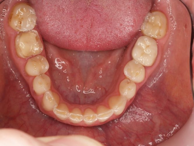 Ryc. 20 a–d. Pacjentka, lat 33, z erozją zębów spowodowaną przez bulimię – stan przed leczeniem.