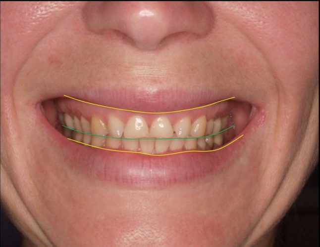 Ryc. 21 a, b. Analiza uśmiechu. Wyraźna różnica ekspozycji brzegów siecznych górnych zębów oraz tkanek wyrostka zębodołowego.