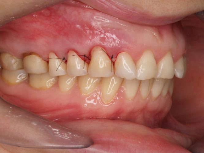 Ryc. 24 a–c. Ponieważ po wstępnym okresie gojenia stwierdzono asymetrię poziomu zenitów dziąsłowych (a), wykonano korektę chirurgiczną przy zębach 13, 14 i 15 (b), co pozwoliło osiągnąć symetryczne długości koron po obu stronach (c).