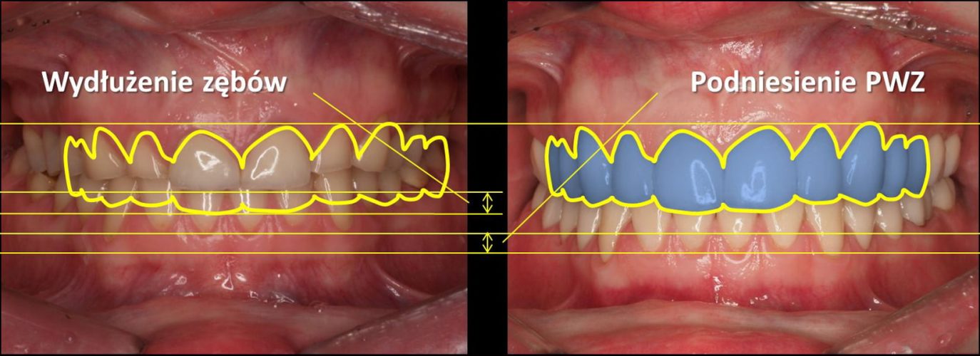 Ryc. 28. W drugim przypadku, w którym nie wykonano zabiegu chirurgicznego wydłużania koron w takim samym stopniu, o ile zostały wydłużone zęby, zwiększeniu uległ pionowy wymiar zwarcia.