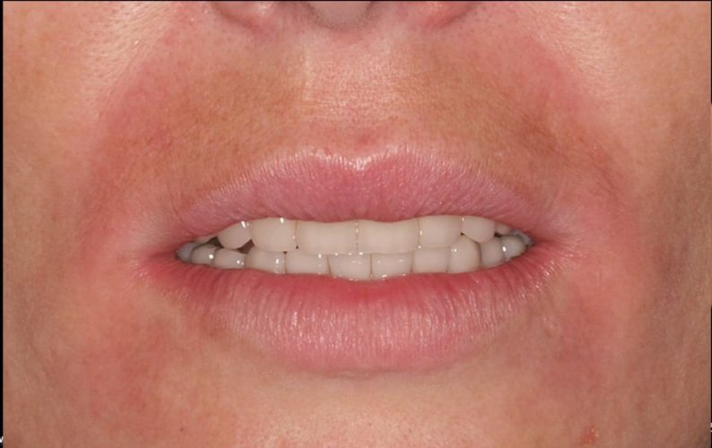 Ryc. 29 a, b. Porównanie rzeczywistej sytuacji po leczeniu pierwszego przypadku (a) z symulacją komputerową (b), w której umieszczono zęby o takiej samej długości jak na rycinie a, ale bez zmiany poziomu zenitów dziąsłowych.