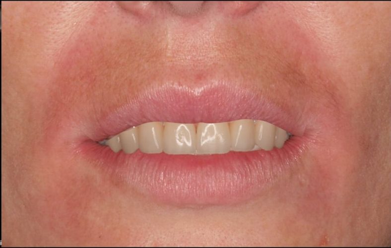 Ryc. 29 a, b. Porównanie rzeczywistej sytuacji po leczeniu pierwszego przypadku (a) z symulacją komputerową (b), w której umieszczono zęby o takiej samej długości jak na rycinie a, ale bez zmiany poziomu zenitów dziąsłowych.