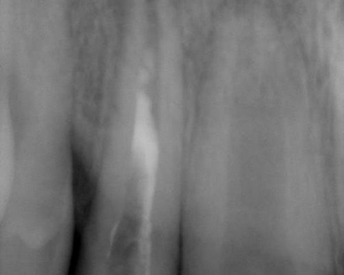 Ryc. 1. Obraz radiologiczny zębów 12 i 11. Korzenie zębów Rc Ao. W okolicy wierzchołka korzenia zęba 12 przejaśnienie świadczące o przewlekłym stanie zapalnym tkanek okołowierzchołkowych.