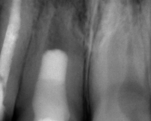 Ryc. 6. Kontrolne badanie radiologiczne zębów po 3 miesiącach.