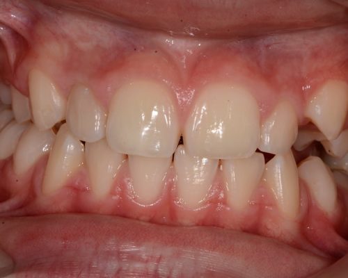Ryc. 8. Wewnątrzustny obraz kliniczny zębów rok po leczeniu.
