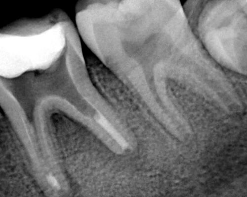 Ryc. 9. Zdjęcie zębowe zęba 46 po wykonaniu trwałej bariery w kanałach.
