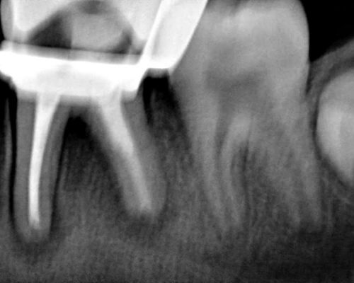 Ryc. 10. Zdjęcie zębowe zęba 46 po wypełnieniu kanałów korzeniowych.
