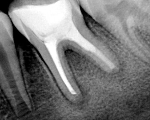 Ryc. 11. Zdjęcie zębowe zęba 46 po 3 miesiącach od wypełnienia kanałów korzeniowych.