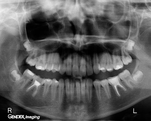 Ryc. 12. Zdjęcie pantomograficzne wykonane po 12 miesiącach od zakończenia leczenia endodontycznego zęba 46.