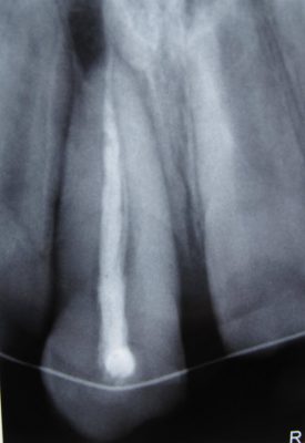 Ryc. 2. Zdjęcie RTG zęba 11 po leczeniu endodontycznym i replantacji.