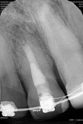 Ryc. 4. Zdjęcie RTG kontrolne wykonane w 3 miesiące po wtórnym leczeniu endodontycznym i zastosowaniu materiału MTA. Zahamowanie resorpcji w zębie 11.