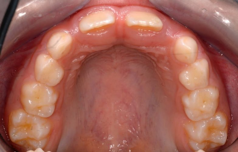 Ryc. 2. Przykład wczesnego leczenia ortodontycznego celem stworzenia miejsca dla brakujących zębów bocznych siecznych – sytuacja wyjściowa.
