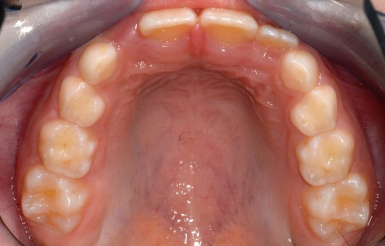 Ryc. 3. Przykład wczesnego leczenia ortodontycznego celem stworzenia miejsca dla brakujących zębów bocznych siecznych – sytuacja wyjściowa.
