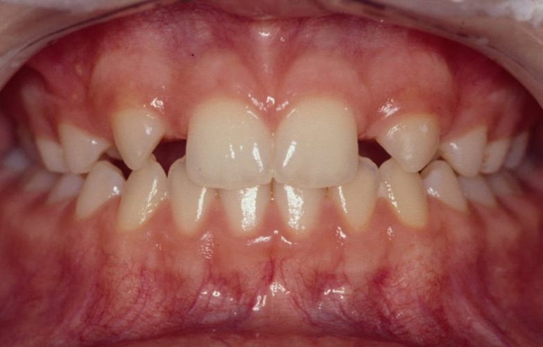 Ryc. 4. Przykład wczesnego leczenia ortodontycznego celem stworzenia miejsca dla brakujących zębów bocznych siecznych – stan w trakcie leczenia.