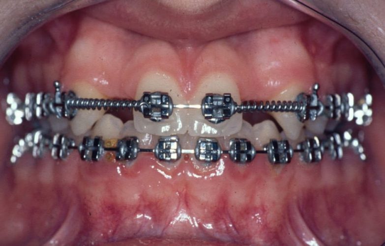 Ryc. 5. Przykład wczesnego leczenia ortodontycznego celem stworzenia miejsca dla brakujących zębów bocznych siecznych – stan w trakcie leczenia.