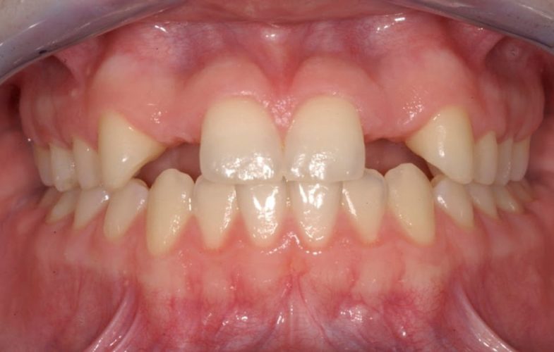 Ryc. 6. Przykład wczesnego leczenia ortodontycznego celem stworzenia miejsca dla brakujących zębów bocznych siecznych – stan w trakcie leczenia.