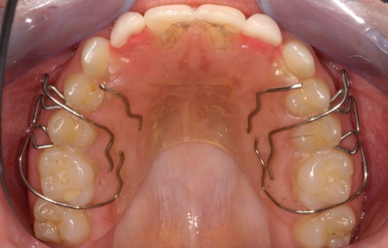 Ryc. 7. Przykład wczesnego leczenia ortodontycznego celem stworzenia miejsca dla brakujących zębów bocznych siecznych – stan w trakcie leczenia.