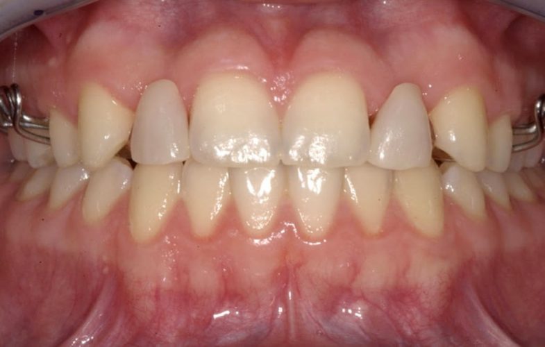 Ryc. 8. Przykład wczesnego leczenia ortodontycznego celem stworzenia miejsca dla brakujących zębów bocznych siecznych – stan w trakcie leczenia.