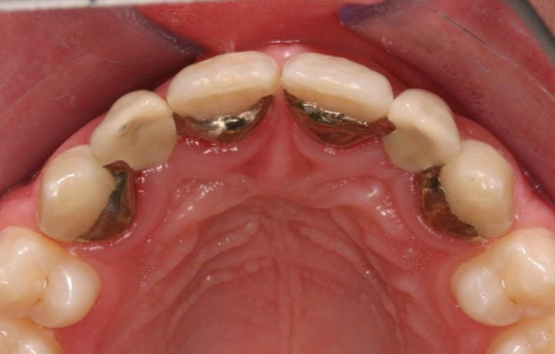 Ryc. 9. Przykład wczesnego leczenia ortodontycznego celem stworzenia miejsca dla brakujących zębów bocznych siecznych – odtworzenie miejsca i zablokowanie poprzez wykonanie mostów typu Maryland.