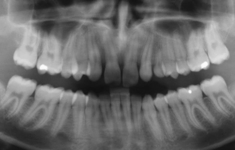 Ryc. 10. Przykład wczesnego leczenia ortodontycznego celem stworzenia miejsca dla brakujących zębów bocznych siecznych – odtworzenie miejsca i zablokowanie poprzez wykonanie mostów typu Maryland.