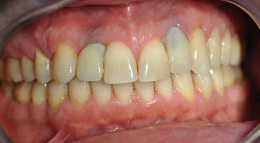 Ryc. 11. Stan po leczeniu ortodontycznym z odtworzeniem miejsca na implanty w okolicy 12 i 22 umożliwiającym uzyskanie optymalnego zgryzu.
