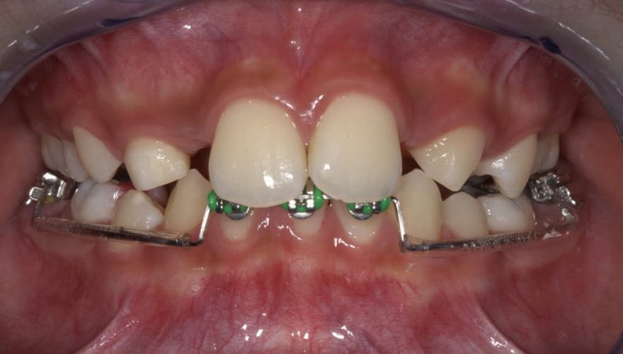 Ryc. 13. Brakujące zawiązki zębów siecznych bocznych szczęki.
